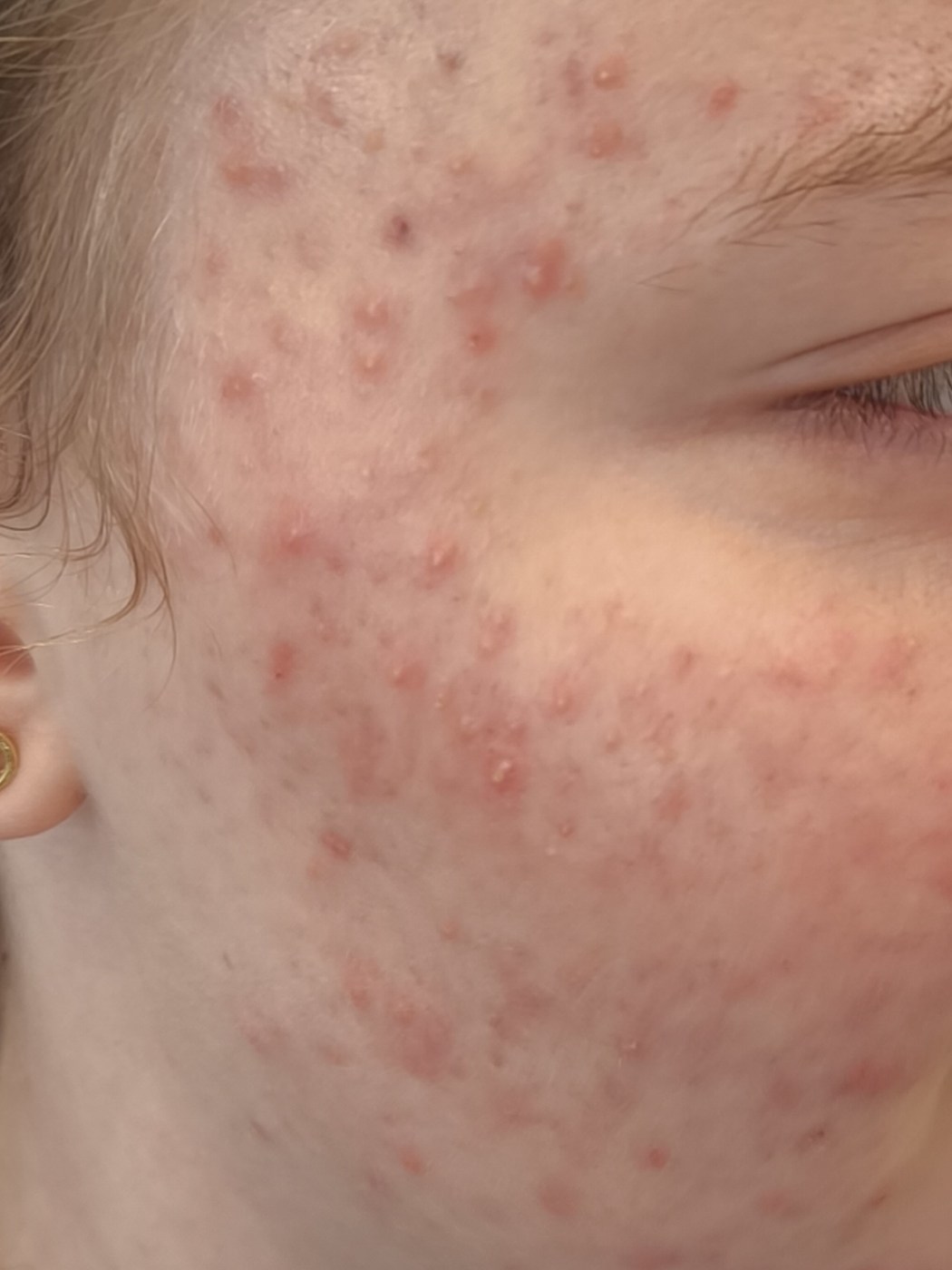 Wange mit ausgepr&auml;gten Unreinheiten vor der Fruchts&auml;urebehandlung